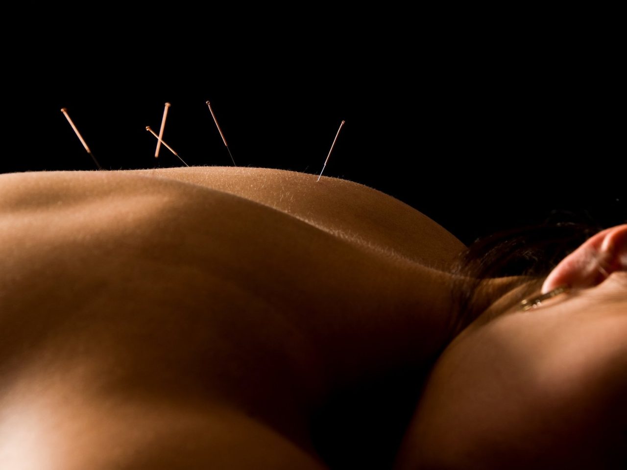 Why Acupuncture Should Be Your Go-To Treatment This Summer