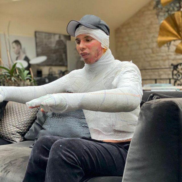 Balmain 創意總監Olivier Rousteing 年前家居意外遭毀容,隱瞞傷勢至今公開始末